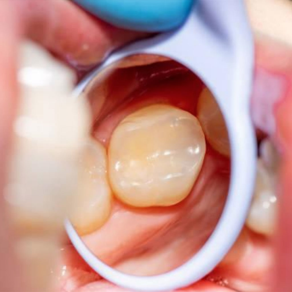 BPA Free Composite Fillings, White Fillings