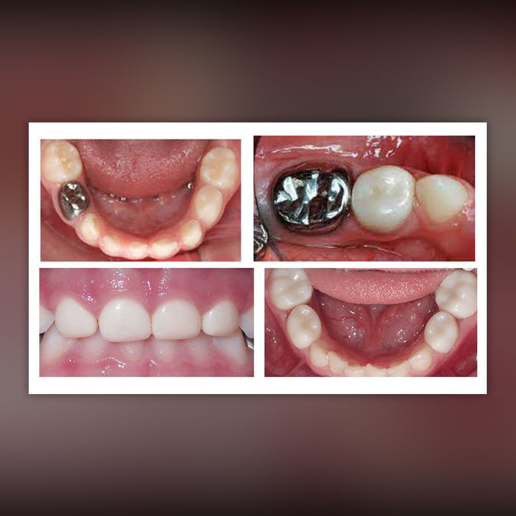 Restorative Chelsea Pediatric Dentistry